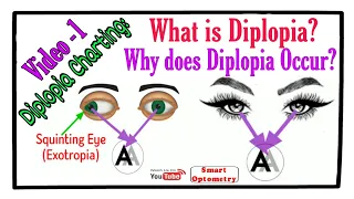 What is Diplopia & Why does Diplopia occur? (Diplopia Charting: Video-1)