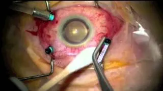 Vitrectomy for Endophthalmitis