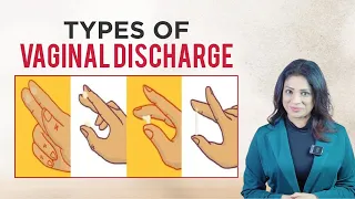 अलग अलग तरीके का VAGINAL DISCHARGE और उनका मतलब | Different colours of vaginal discharge |