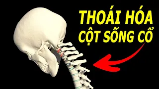 Dấu hiệu thoái hóa cột sống cổ ít ai ngờ đến