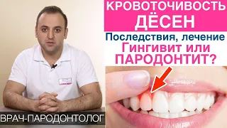 Кровоточивость десен - причины, последствия, лечение! Гингивит и пародонтит - что делать?