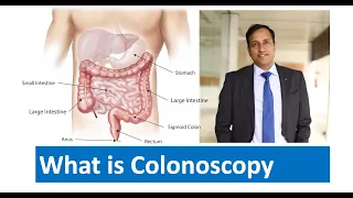 What is colonoscopy : By Dr Vikas Singla
