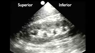 How To: Renal Ultrasound - Hydronephrosis Case Study Video