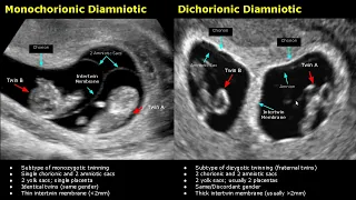 Fetal Twins Ultrasound Normal Vs Abnormal | Monochorionic/Dichorionic/Diamniotic/Monoamniotic USG