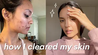 how I cleared my skin naturally | hormonal acne for dry & sensitive skin