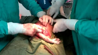 second stage caesarean section  Dr Rahuldeo Jadhao
