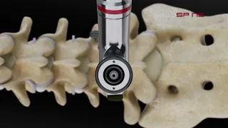 RIWOspine Full-Endoscopic Lumbar Interbody Fusion