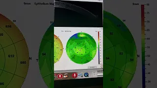 50 yo with new keratoconus in one eye Kanellopoulos MD