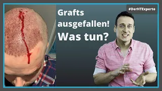 Haartransplantation: Wann sind die Grafts fest? [Krusten fallen mit Haaren ab]