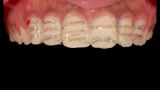 Step by Step Veneer Preparation And Cementation | EMAX Porcelain Veneer | Clinical case