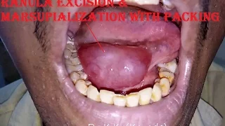 Ranula Excision & Marsupialization with Packing