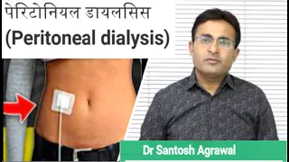 PERITONEAL DIALYSIS I पेरिटोनियल डायलिसिस I Kidney Failure I Dr Santosh Agrawal, Bansal Hospital.