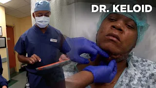 DR. KELOID PATIENT GETS PAINFUL KELOID REMOVED