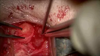 Direct cannulation of superior ophthalmic vein for CCF - 1