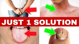 Just 1 Solution To Control infection ,Candida, Leukorrhea, Yeast Over Growth