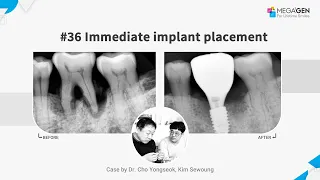 Dr. Yongseok CHO, Sewoung KIM, #36 immediate implant surgery and prosthesis