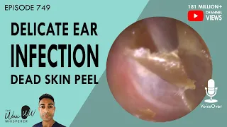 749 - Delicate Ear Infection Ear Wax Removal