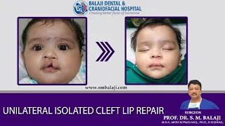 Unilateral Isolated Cleft Lip Repair Before And After Video