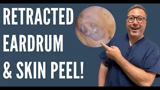 EAR WAX REMOVAL, RETRACTED EARDRUM AND SKIN REMOVAL - EP455