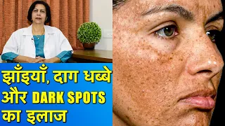 झाँइयाँ, Dark Spots और दाग धब्बों का इलाज || Hyperpigmentation Treatment