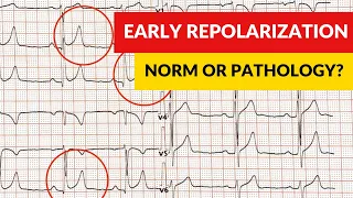 Early repolarization syndrome and pattern. Norm or pathology?