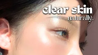 How I Cleared My Skin In 8 Weeks *naturally*