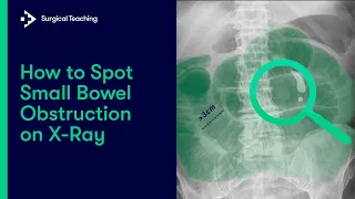 Small Bowel Obstruction | How do we Diagnose it on Abdominal X-Ray?