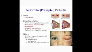 🌀 Peri orbital  cellulitis 🌀