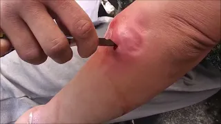 Extreme abscess, satisfying cyst and boil popping compilation