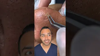 OMG I was not expecting that blackhead extraction on the nose! Dr Somji reacts
