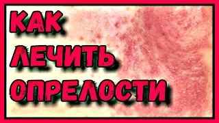 ИЗБАВЛЯЕМСЯ от опрелостей за 1 день!