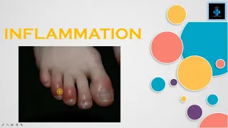 what causes inflammations? | pathology | mechanism | vascular and cellular events | swellings