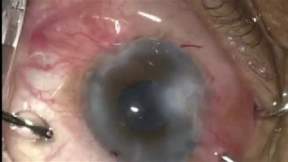 Atheeshwar Das Phaco in corneal opacity