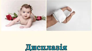 Дисплазія у немовлят. Формування суглобів у дитини.
