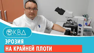 💣 Эрозия на крайней плоти.  Клинический случай №408