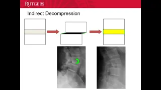 Matthew Diehl, MD - Extreme Spine Surgery: The Transpsoas Approach to Lumbar Interbody Fusion