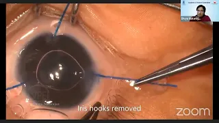 AIOS ARC Top Pearls in Cataract - DR. DIVYA NATARAJAN