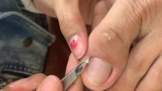 HOW TO CUT THICK TOENAILS - Toenail Cleaning Satisfying #270