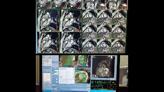 MRI Cardiac for chambers viability in GE HDXT 1.5 T