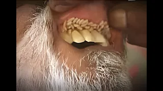 فديو (3) مريض تخرج الديدان من فمه مصاب بداء النغف الفموي  #oral_myiasis