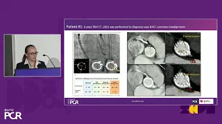 How to overcome the most clinically relevant challenges in TAVI - EuroPCR 2024