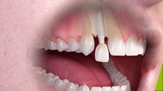 Trattamento singolo dente su impianto in ceramica