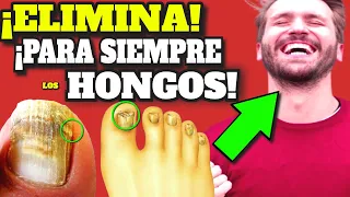 ¡NUNCA MÁS SENTIRÁS VERGUENZA DE TUS UÑAS!| CURAR para SIEMPRE HONGOS en las UÑAS (ONICOMICOSIS)