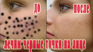 ★ black dots on his face. Nine 100% but working methods of the face to get rid of blackheads.