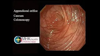 Colonoscopy -Appendiceal orifice and caecum