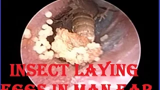 Otoendoscopic Microsuction Ear Cleaning : Alive insect (Fly) & her Eggs removal from Ear Canal