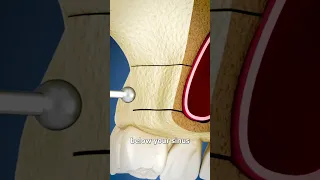 Sinus Lift Surgery Explained 🤔