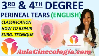 HOW TO REPAIR THIRD AND FOURTH DEGREE PERINEAL TEAR: SURGICAL TECNIQUE. - Gynecology and Obstetrics