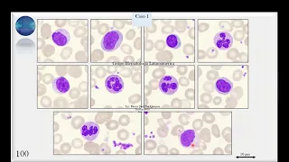 Revisando casos en el PEEC Citomorfología Hemática CICLO 2023