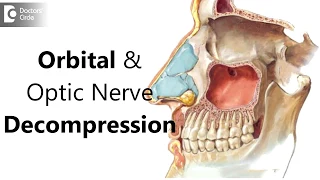 What is orbital and optic nerve decompression? Signs, Symptoms, Diagnosis - Dr. Harihara Murthy